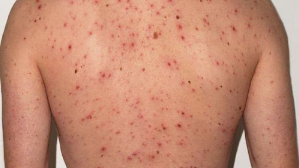 Refuerzan vigilancia por caso de Sarampión en Buenos Aires