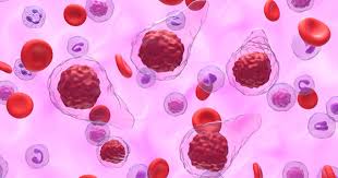  El desafío de la anemia y la llegada de un tratamiento que cambia el pronóstico
