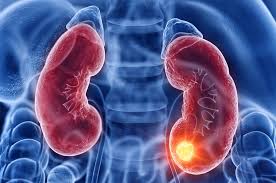 Cáncer de riñón: la enfermedad silenciosa que podría causar más de 2.500 muertes al año en Argentina