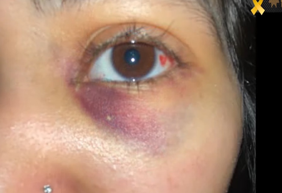 Denuncian una agresión a una alumna del Liceo Ferré: sufrió una fractura en el rostro y deberá ser operada