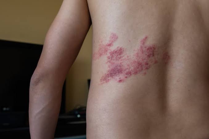Día Mundial del Corazón: el herpes zóster, un factor de riesgo cardiovascular no tan conocido